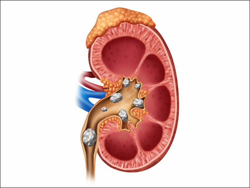 Health And Fitness : Remedies For Kidney Stone किडनी स्टोन ठीक करने के उपाय